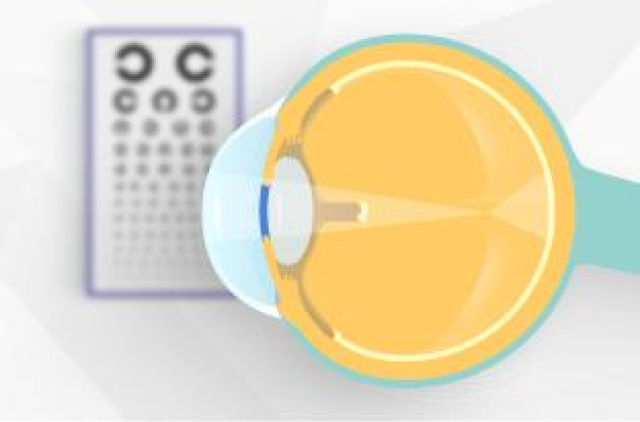 Признаки и контроль миопии у детей